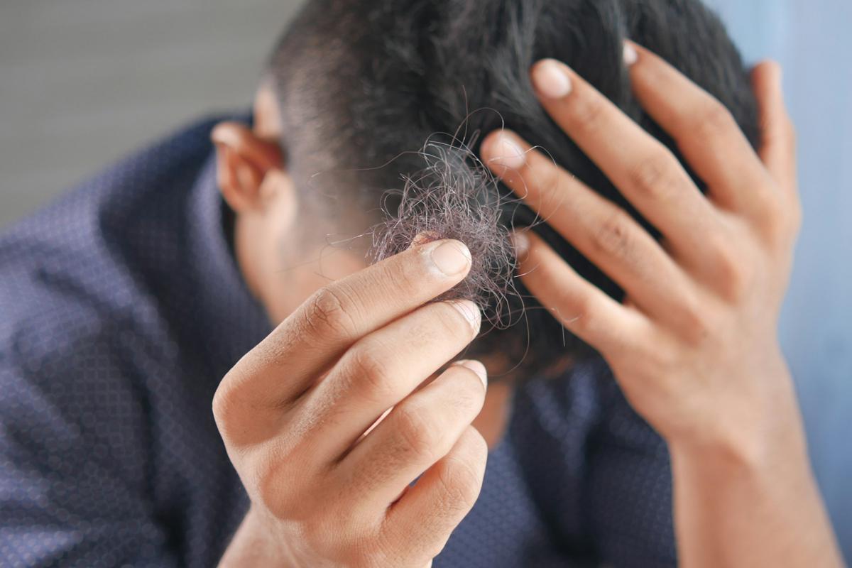 Causes of a Receding Hairline in Men: Why Is My Hairline Receding?