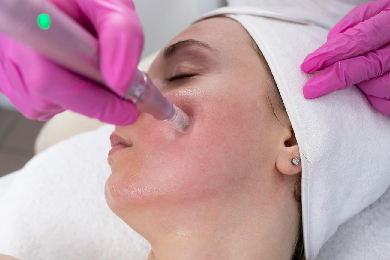 Guide to Microneedling: What Is Microneedling & How Does It Work