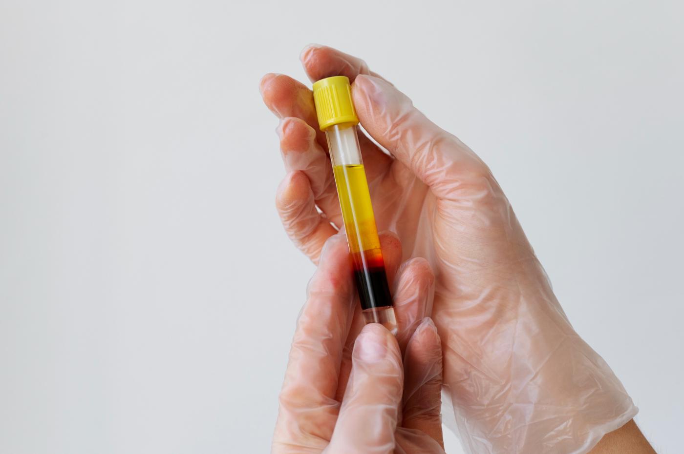 Hand holding vial for prp treatments close up